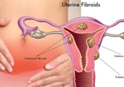 Uterine Fibroids