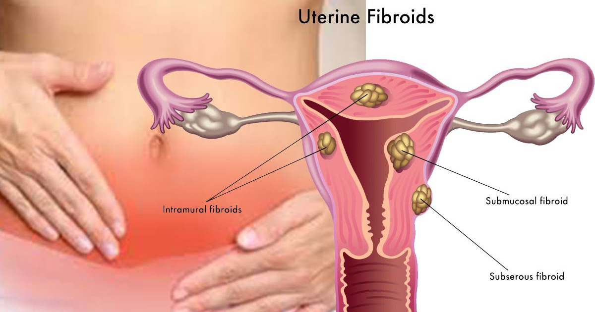 Uterine Fibroids